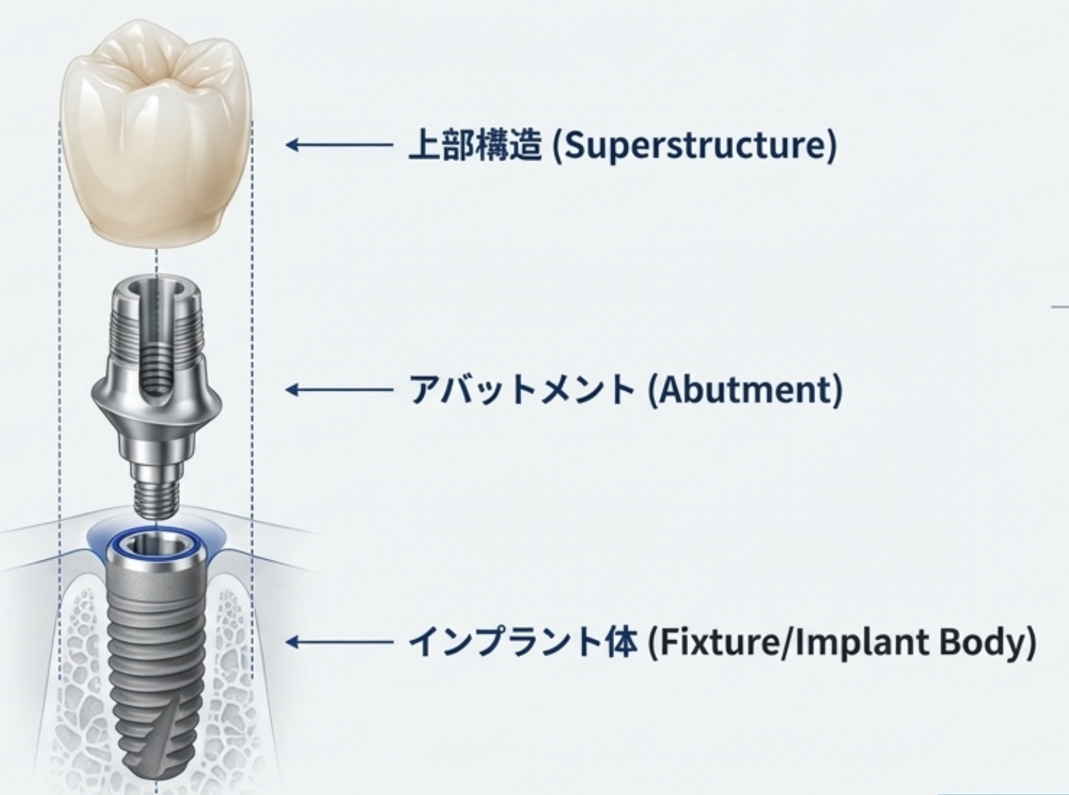 インプラントの構造図