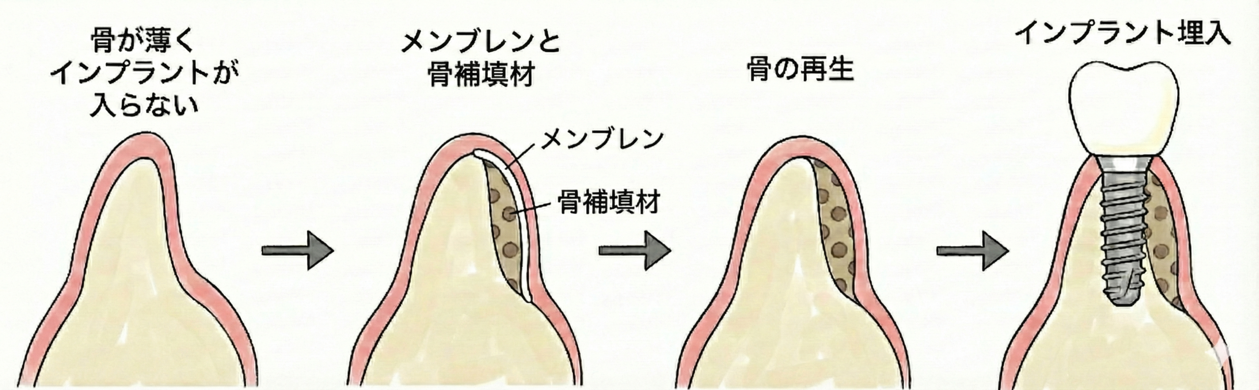 GBR法のイメージ図